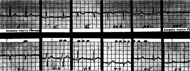 Aanyas irregular heartbeat some valve regurtitation