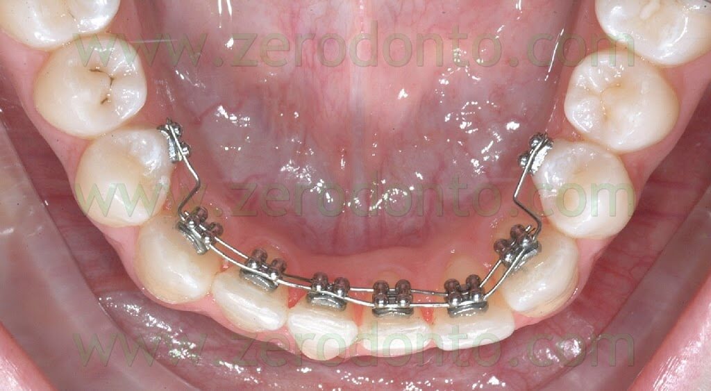 Governor recomended facial braces07personally made cumpilation
