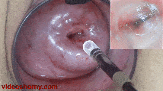 best of Walls with cervix vaginal speculum inspecting