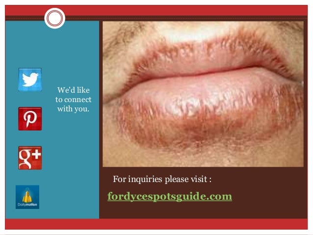 Pearly penile papules removal join link